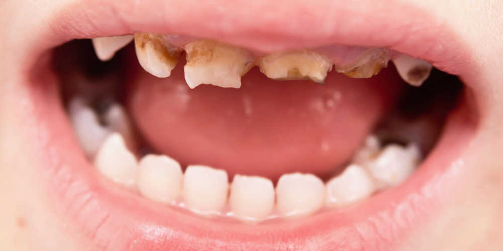 Child's tooth decay