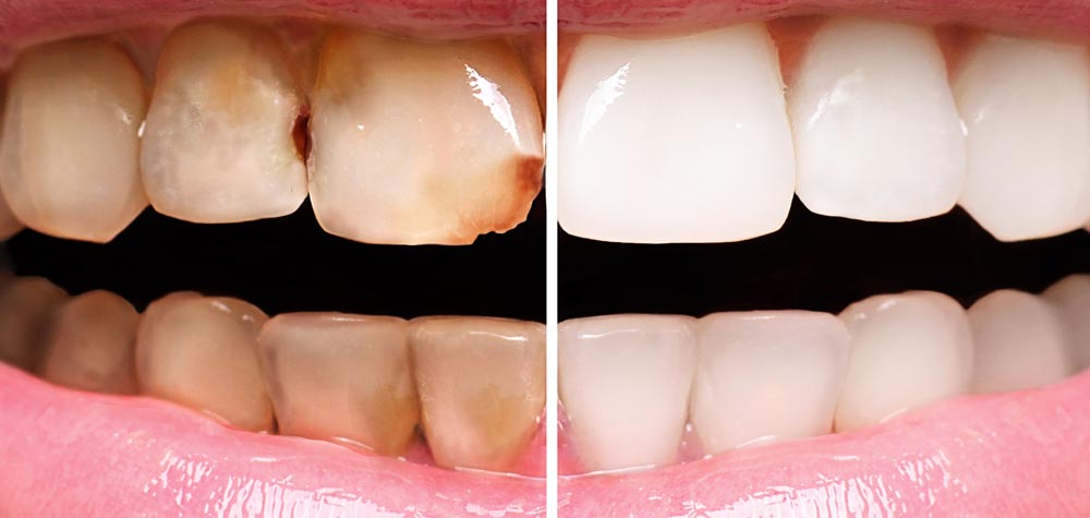 Before and after teeth whitening
