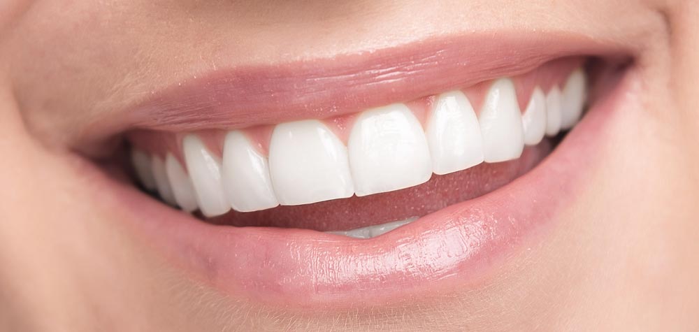 Teeth whitening